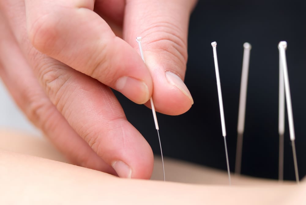 Acupuncture and FAQs