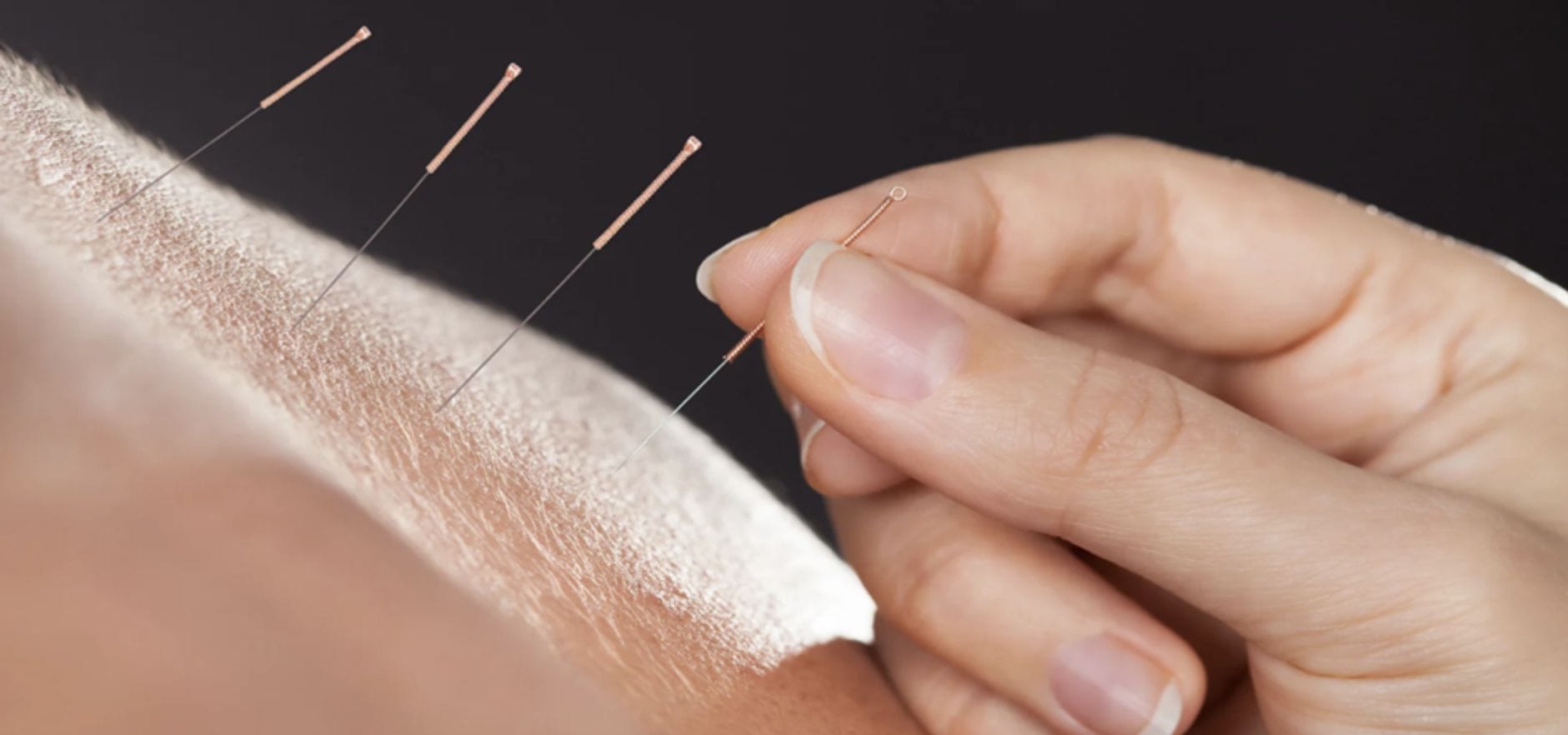 Achieve Neuro Acupuncture™ in Retford, UK